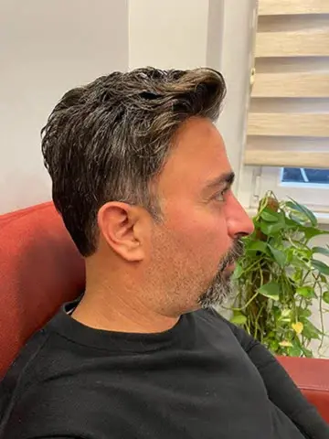 Hair Hotel erkek önce sonra