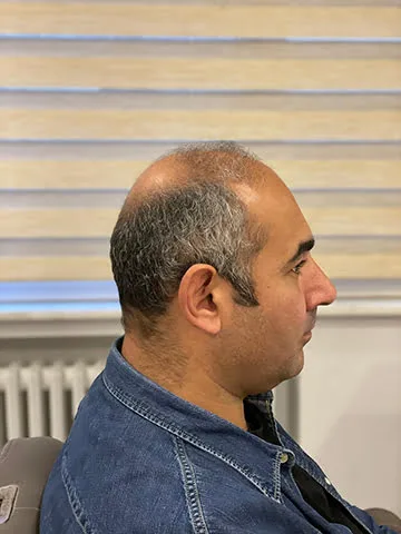 Hair Hotel erkek önce sonra