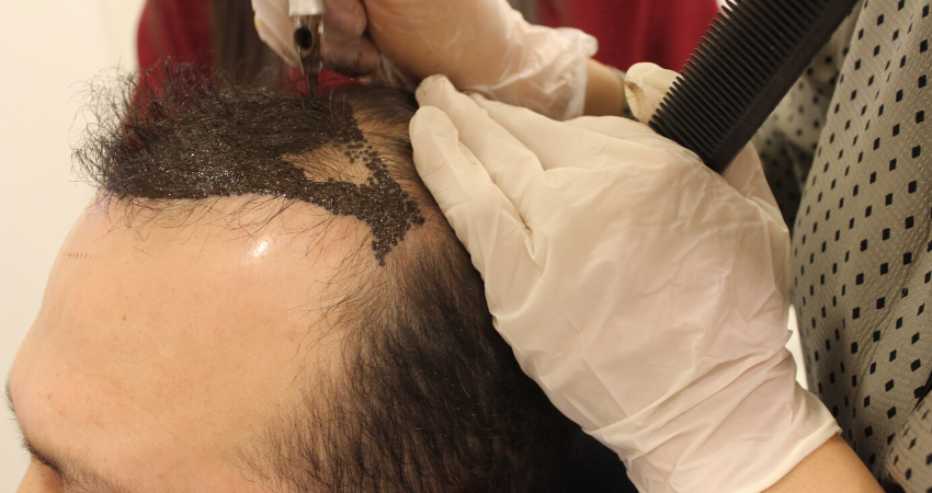 Male Eyebrows, Scalp Micro Pigmentation SMP Hair Tattoo by El Truchan