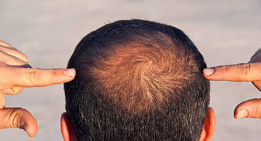 Best Solution to Baldness Problem