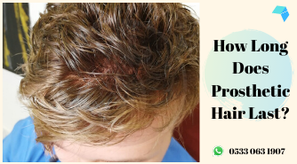 How Long Does Prosthetic Hair Last? 