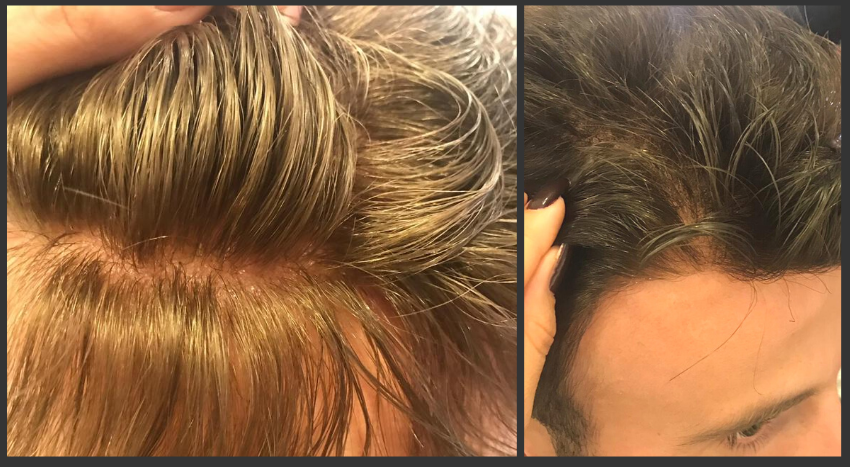PROS AND CONS OF MESHED SUBSTRUCTURE IN PROSTHETIC HAIR
