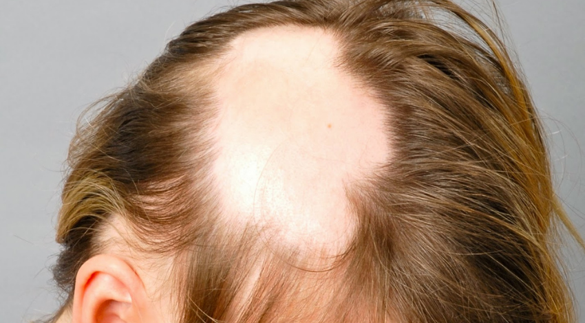Saç Kıran ve Protez Saç İle Çözümü