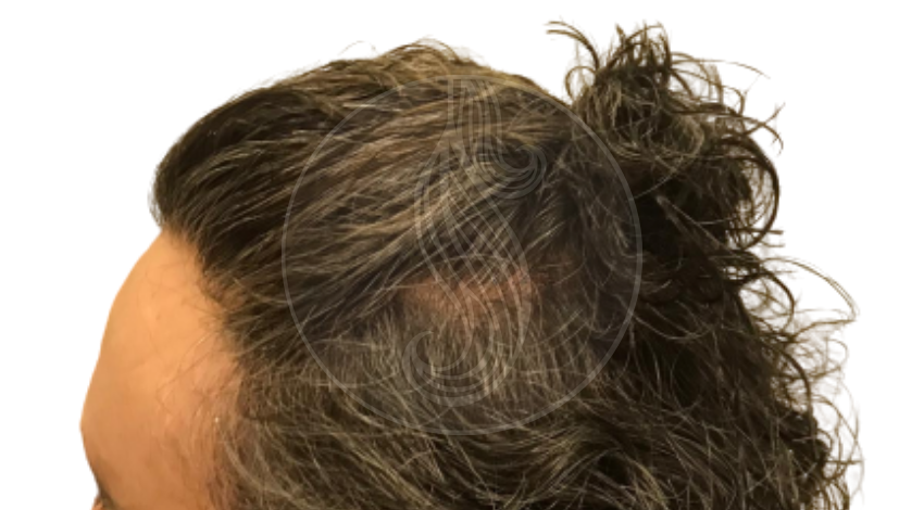 Saç Protezi Hakkındaki Yanlış bilgiler