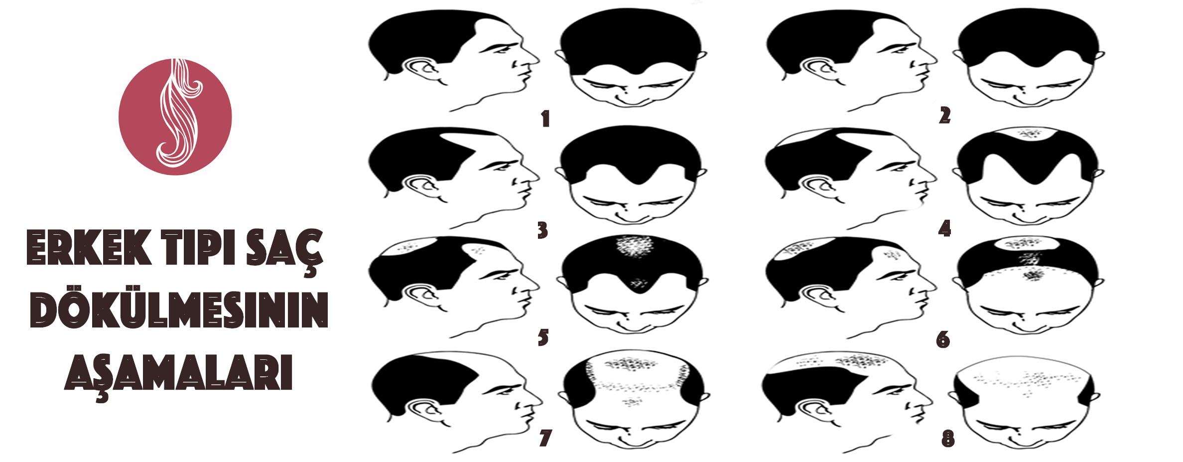 Staged Sample of Male Type Hair Loss