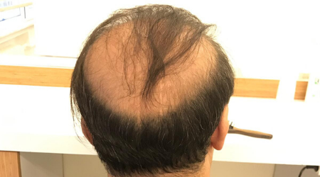 What Do You Know About Your Hair Loss 