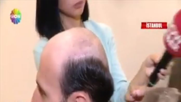 Hair Hotel Saç Protezi Merkezi Show Tv Ana Haber