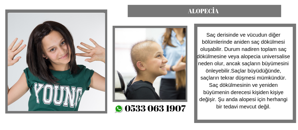 Alopecia - Alopesi