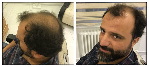 Androgenetic Hair loss