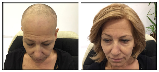 Hair Loss Due To Chemotherapy