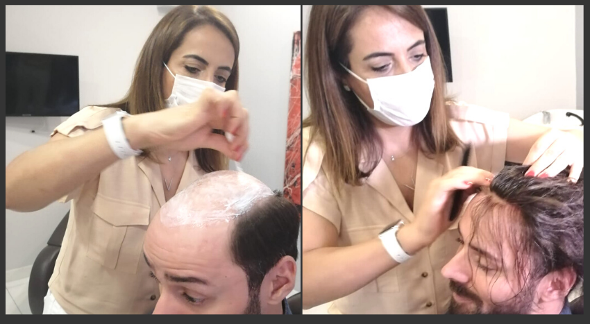 TAPE FREE PROSTHETIC HAIR SYSTEMS